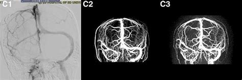 Mrv On Admission Indicated The Possible Thrombosis In Right Transverse