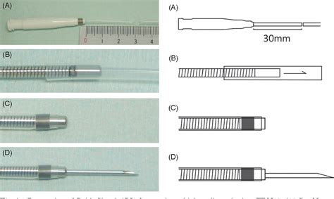 Pdf Transbronchial Needle Aspiration Through A Guide Sheath With