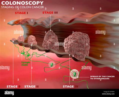 Colorectal Cancer Hi Res Stock Photography And Images Alamy