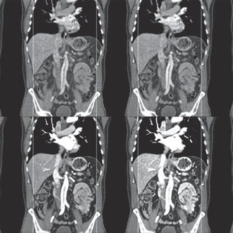 Year Old Man With Aortic Dissection Calculated Monoenergetic