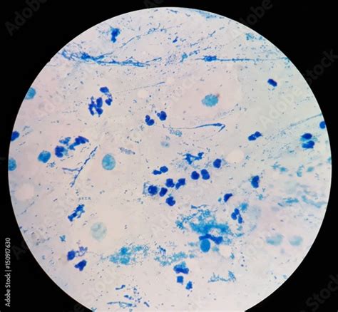 Smear of Acid-Fast bacilli (AFB) stained from sputum specimen, under ...