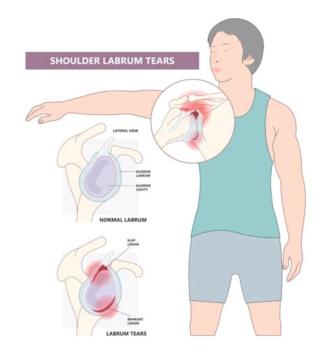 Does A Shoulder Labrum Tear Require Surgery Joint Rehab And Sports