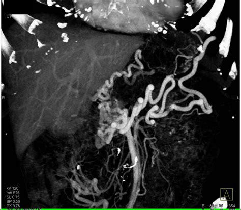 Pancreatic Cancer Encases And Occludes The Portal Vein Smv Confluence