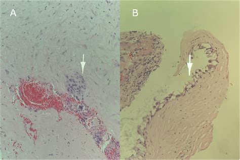 Histopathology From Pleural Biopsy Hematoxylin Eosin Staining 20×