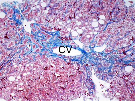 Pathology Outlines - Nonalcoholic fatty liver disease / nonalcoholic ...