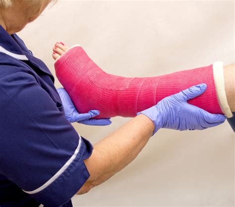 Synthethic Casts Cast Bandages And Other Splints Praxisdienst