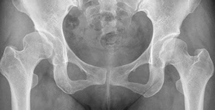 Adult Hip Dysplasia