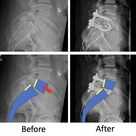 Spondylolisthesis — Matthew Mian Md