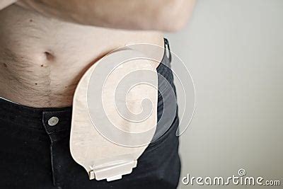 Front View On Colostomy Bag Attached To Man Patient Medical Theme