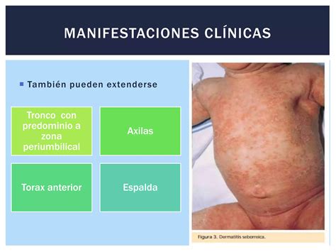 Dermatitis Seborreica Infantil Ppt