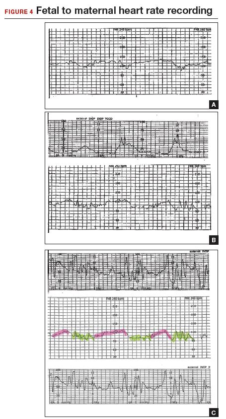 How To Differentiate Maternal From Fetal Heart Rate Patterns On