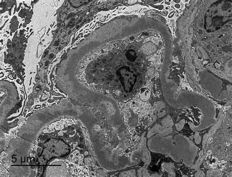 Pathology Outlines C3 Glomerulonephritis Dense Deposit Disease