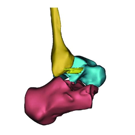 A 3 Dimensional Reconstruction Model Showing An Anterior Talofibular