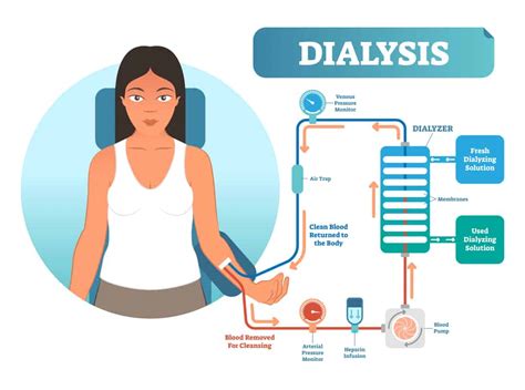 Who Uses Liver Dialysis And What Is It Hepatitis Central