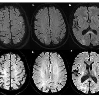 Brain Magnetic Resonance Imaging In Follow Up Brain Mri Showed New