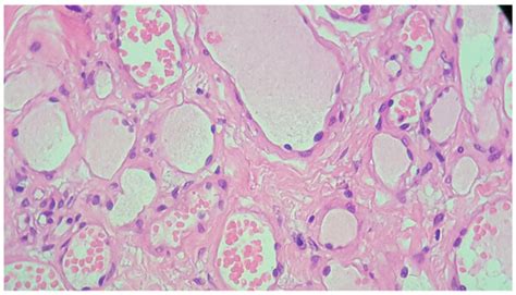 Medicina Free Full Text Management Of Capillary Hemangioma Of The