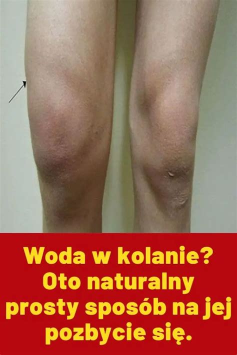 Woda w kolanie Oto naturalny prosty sposób na jej pozbycie się