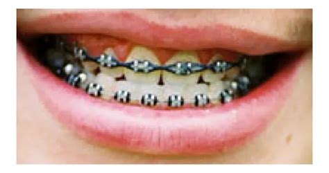 Ppt Common Types Of Dental Braces Powerpoint Presentation Free Download Id 11895737