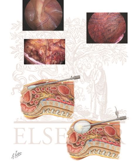 Indirect And Direct Inguinal Hernias Continued Transabdominal