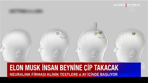 Elon Musk Neuralinkin Beyin Ipinin Ay I Inde Insan Denemelerine