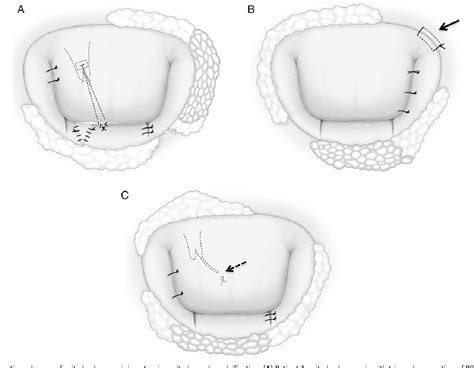 Figure 1 From Mitral Valve Repair Without Mitral Annuloplasty With