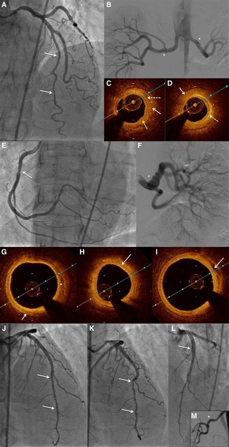 Angiographic And Intracoronary Manifestations Of Coronary Fibromuscular