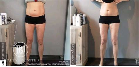 LPG Endermologie Beauty Unlimited Amsterdam