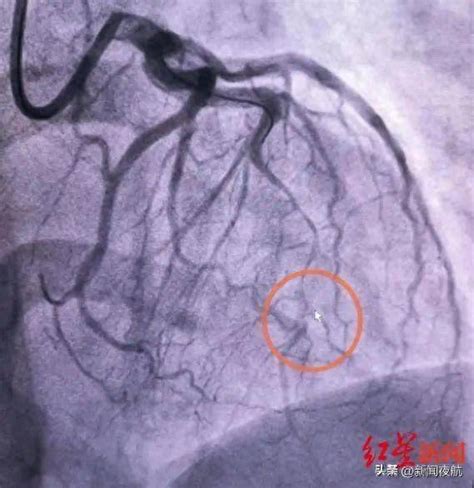 给孩子辅导作业，女子竟被气成冠脉撕裂心梗！医生提醒心血管症状胸痛