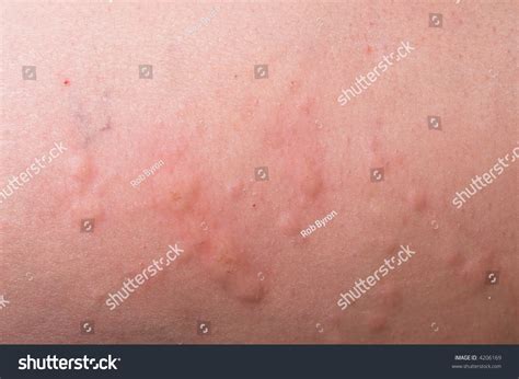 Hives Severe Allergic Reaction Stock Photo 4206169 - Shutterstock