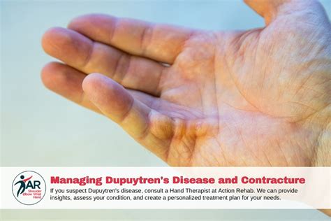 Managing Dupuytren S Disease And Contracture Action Rehab