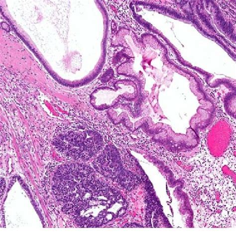 (PDF) Gastric Hyperplastic Polyps: A Review