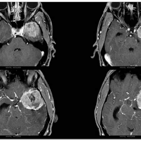 Initial Presentation Brain T Weighted Post Contrast Axial