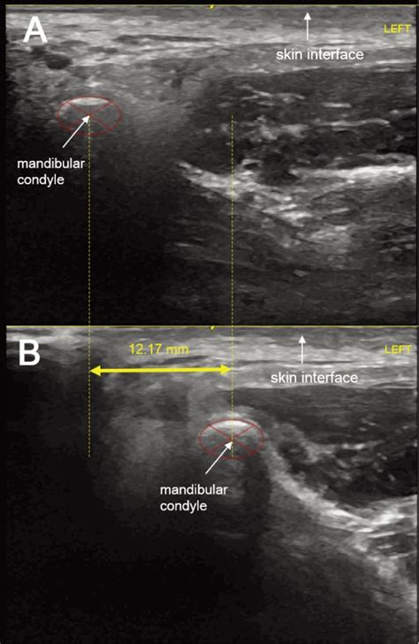 Measurement Of Anterior Translation Of The Mandibular Condyle Using