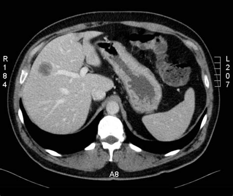 Ct Scan Showing A Solid Liver Tumor Measuring ~3 Cm Open I