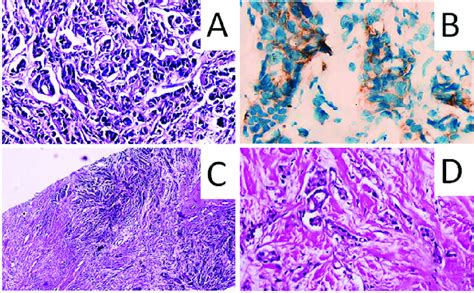 Another Example Of Immunohistochemical Staining Results A Hematoxylin