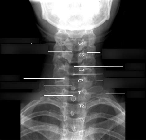 Radiographic Anatomy Ap Axial Cervical Spine Diagram Quizlet