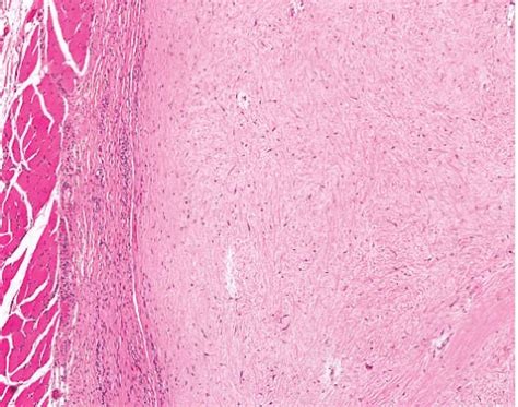 Liposarcoma | Basicmedical Key