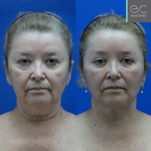 Face Lift Full Mini Before And After Evoclinic