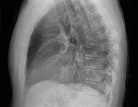 Normal Chest X Ray Anatomy Tutorial Kenhub 43 Off