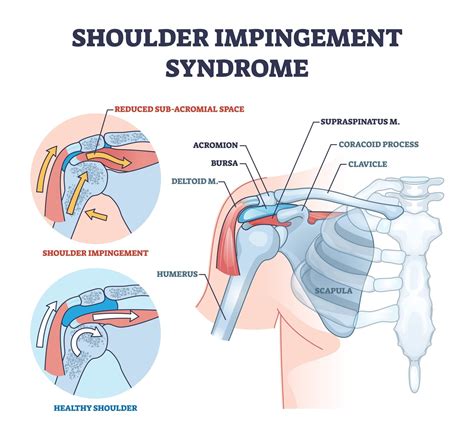 Impingement Syndrome - Physioflow PT | Physical Therapy | Vancouver, WA