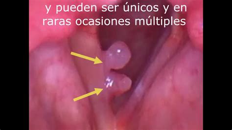 P Lipos De Cuerdas Vocales Gemelos Twin Polyps P Lipos M Ltiples