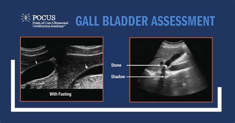 Gall Bladder Assessment Pocus Resources And Case Studies