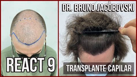 REACT 9 Transplante Capilar Dr Bruno Jacobovski YouTube