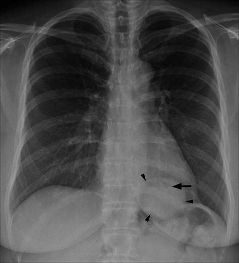 Epiphrenic Esophageal Diverticulum Abstract Europe PMC