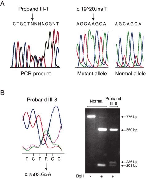 Detection Of Mutations In The CASR Gene A Left Panel Direct Sequence