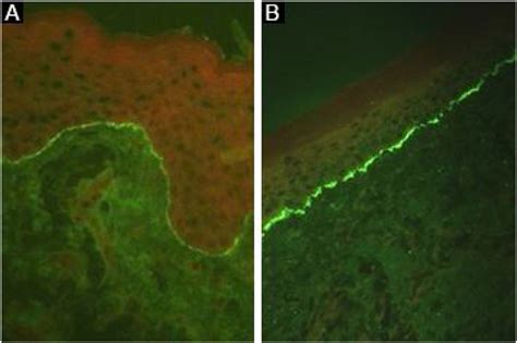 Epidermolysis Bullosa Acquisita Immunofluorescence