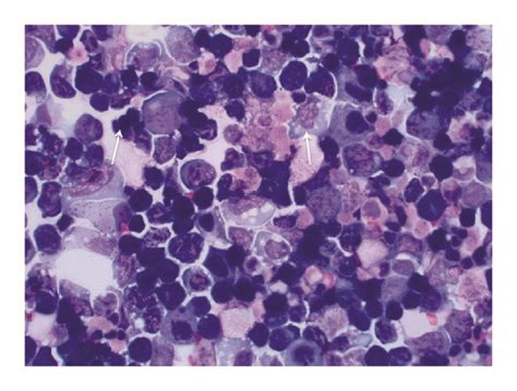 Ascitic Fluid Cytology With Diff Quick Stain Demonstrating Large Download Scientific Diagram