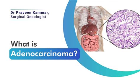 What is Adenocarcinoma: Types, Symptoms, and Treatment