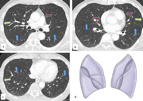 5 The Pleura Radiology Key