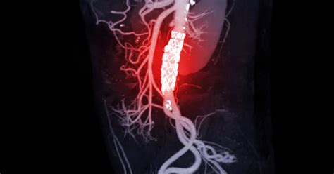 Uk Researchers Help Understand Sex Specific Differences In Aortic Aneurysms Uknow